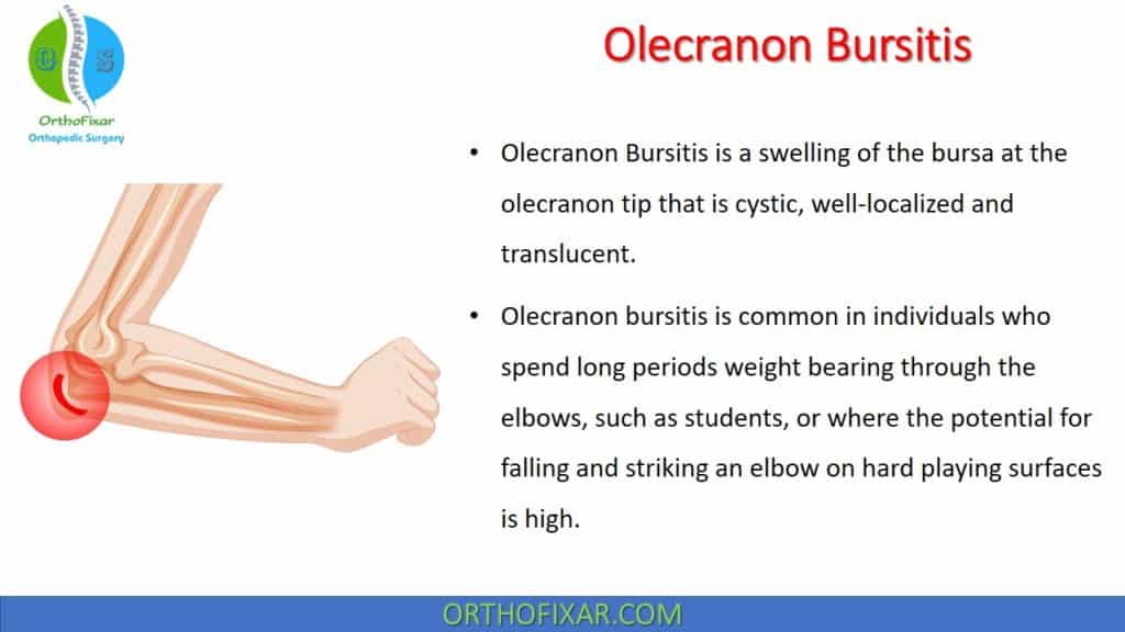 Olecranon Bursitis Symptoms Treatment OrthoFixar 2025