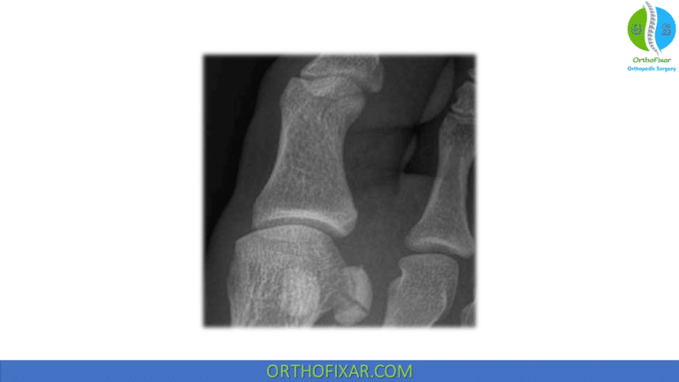 Sesamoid Fracture Broken Sesamoid OrthoFixar 2024