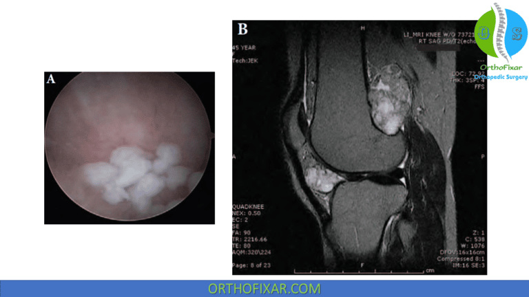 Arthroscopic Knee Synovectomy OrthoFixar 2025