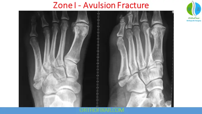 5th Metatarsal Base Avulsion Fracture (Pseudo-Jones Fracture)
