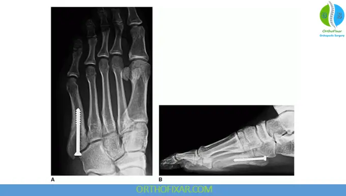 5th Metatarsal Base Fractures surgical treatment