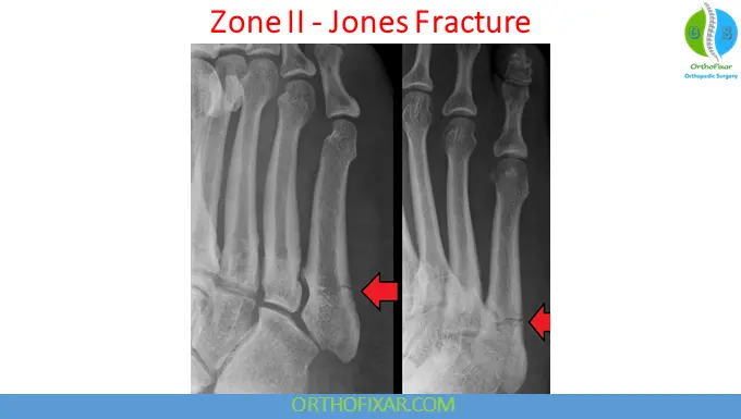 5th Metatarsal Base Fractures zone 2- Jones Fracture