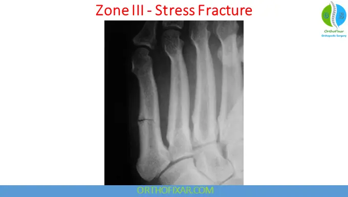 5th Metatarsal Base Fractures zone 3 - stress fracture