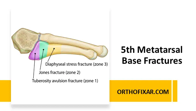 5th Metatarsal Base Fractures