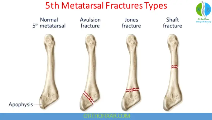 5th Metatarsal Fracture types