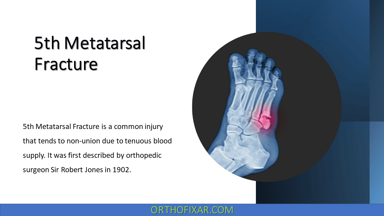 5th Metatarsal Fracture