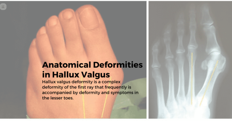 hallux valgus anatomical deformities