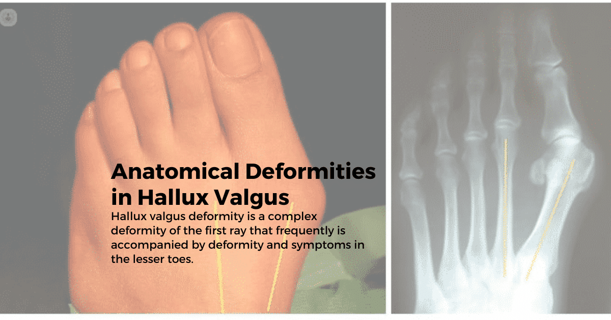 Anatomical Deformities in Hallux Valgus