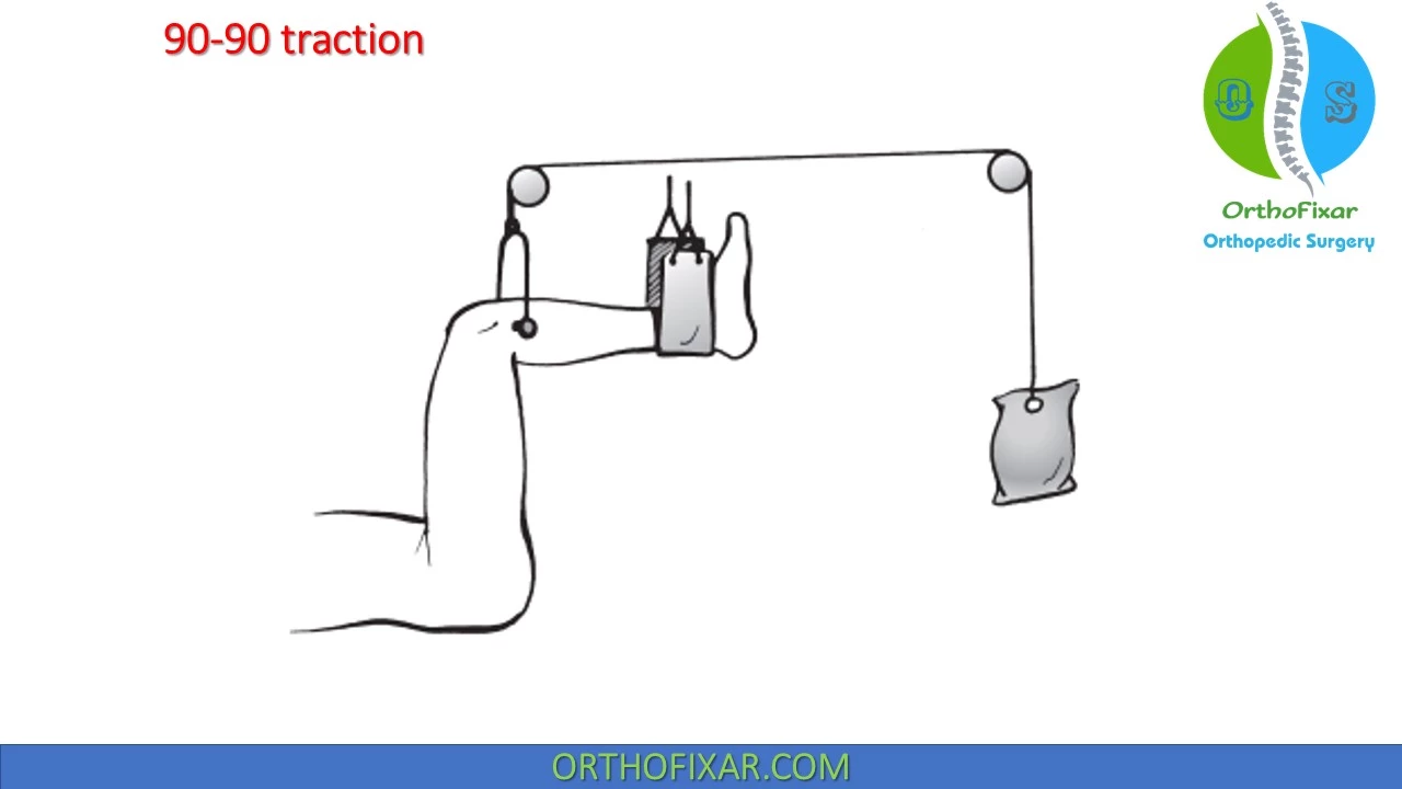 Skeletal Traction  Types, Principles & Complications - Video