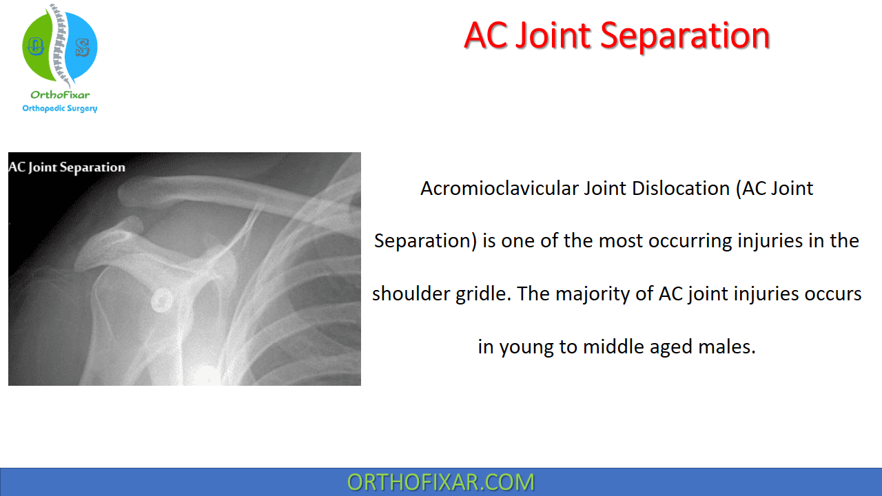 acromioclavicular joint dislocation x ray