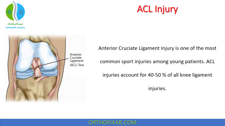 Anterior Cruciate Ligament Injury