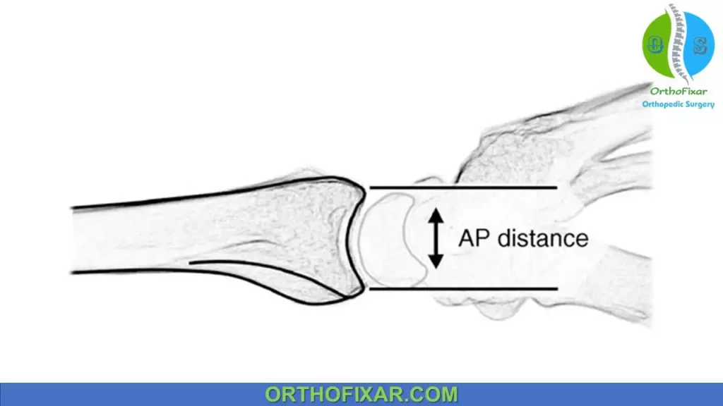 AP distance distal radius