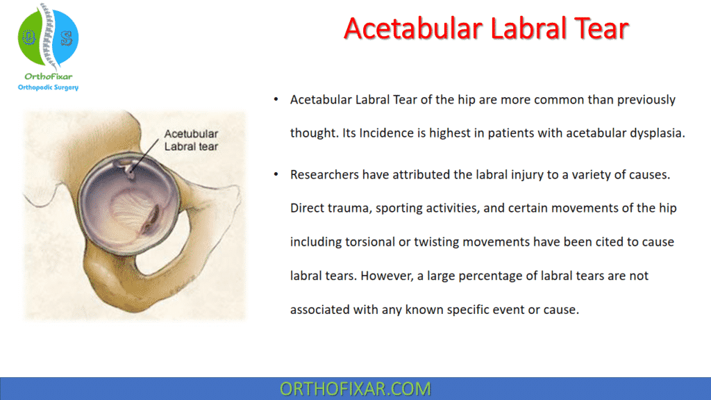 Acetabular Labral Tear | OrthoFixar 2024