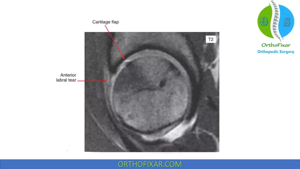 Acetabular Labral Tear on MRI