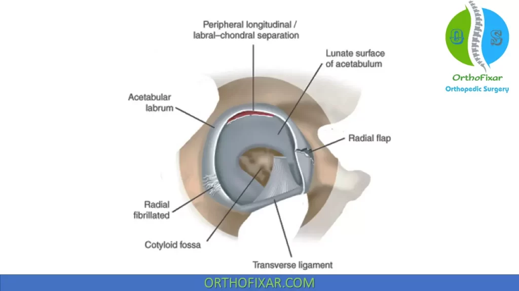 Acetabular Labral Tear types