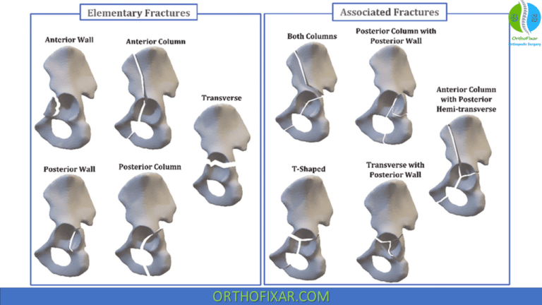 Acetabulum Fracture Full Explained | OrthoFixar 2024