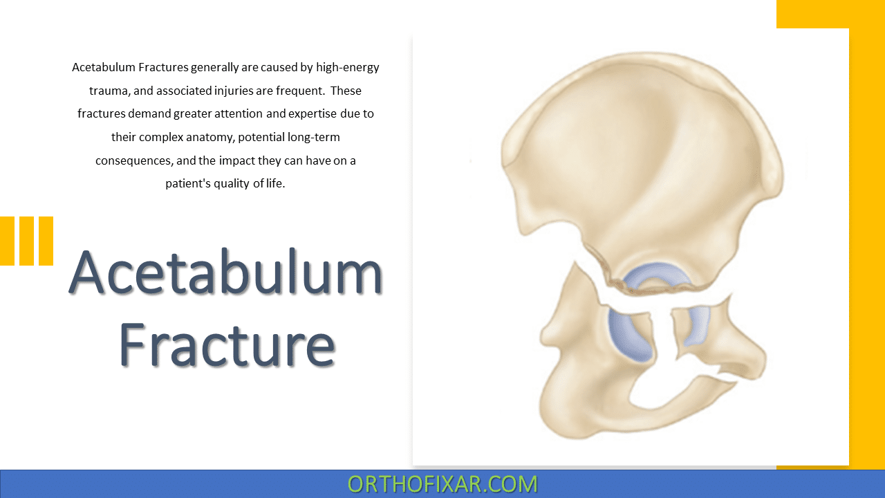  Acetabulum Fracture 