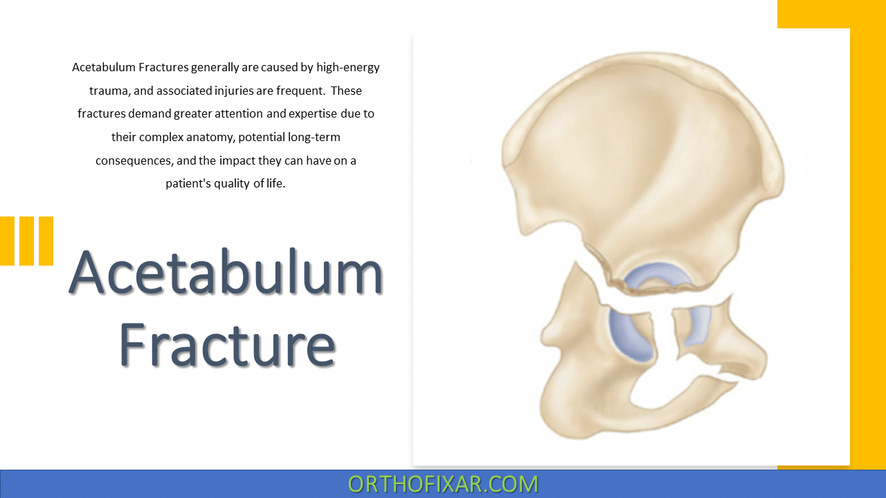 Acetabulum Fracture Full Explained | OrthoFixar 2025