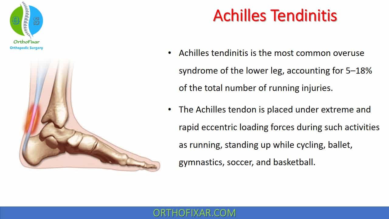 Achilles deals tendon causes