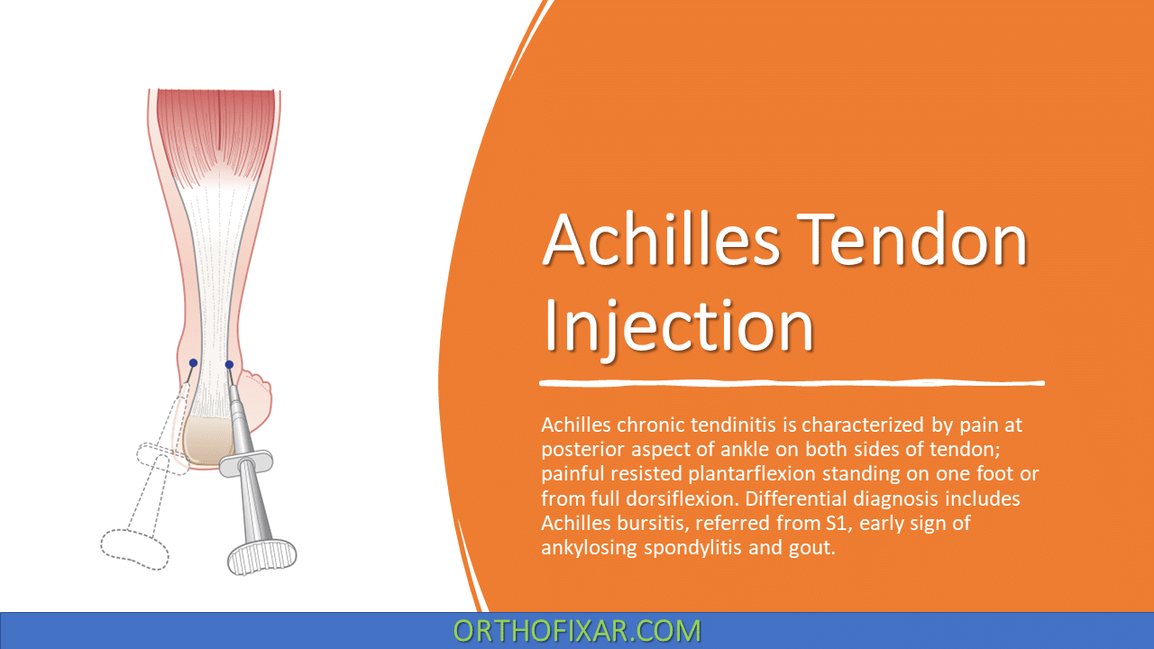  Achilles Tendon Injection 