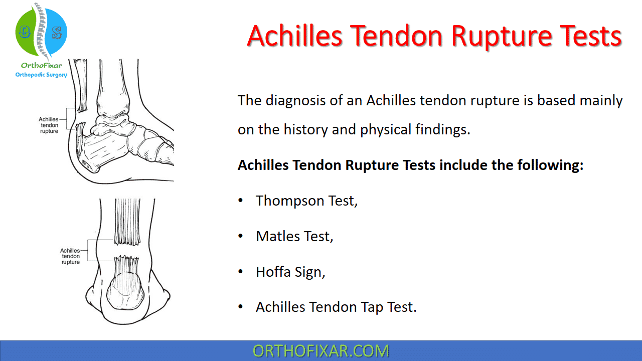 Achilles Tendon Rupture Tests Orthofixar 2024 