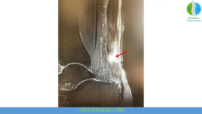 Achilles Tendon Rupture mri