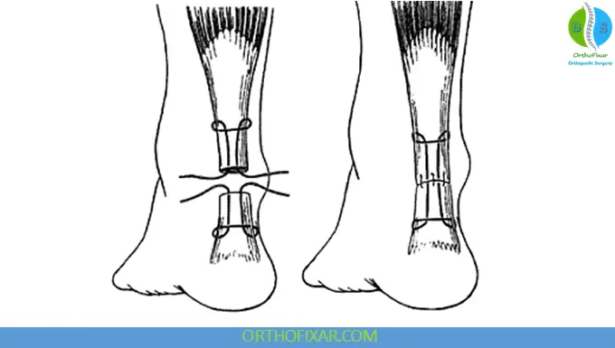 Achilles Tendon Rupture repair
