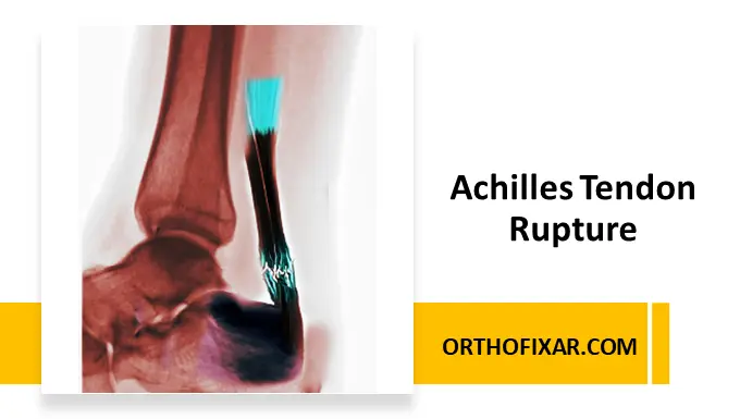 Achilles Tendon Rupture