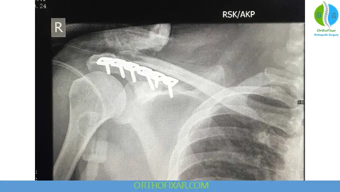 Acromial Fractures: Diagnosis, Classification & Treatment 9 Acromial Fracture treatment with fixation