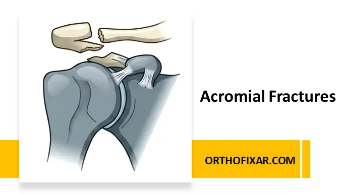 Acromial Fractures