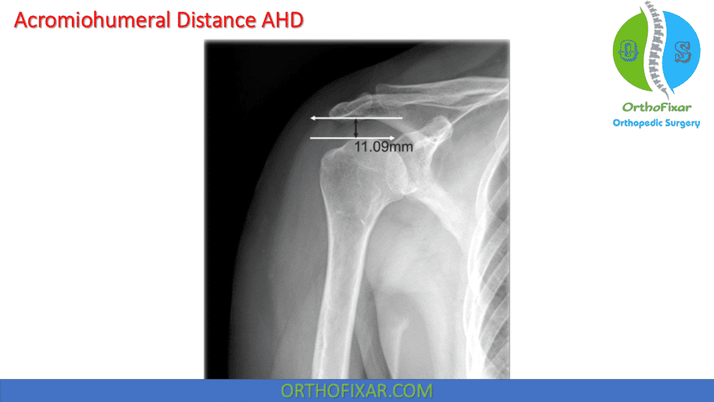 Acromiohumeral Distance AHD