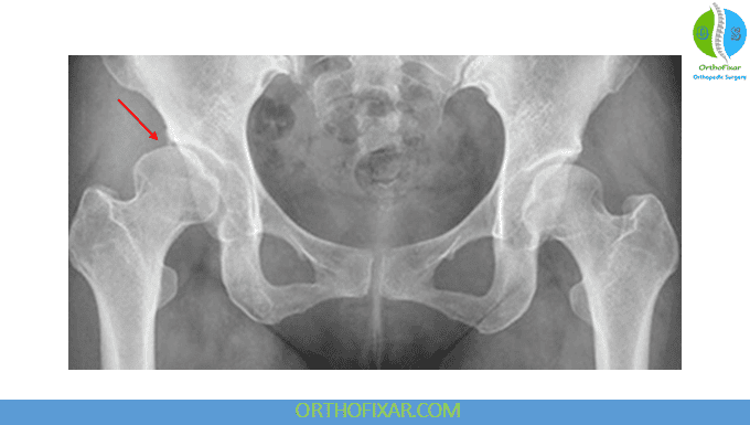 Adult Hip Dysplasia xray