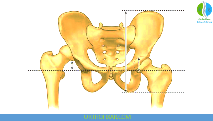 Adult Hip Dysplasia