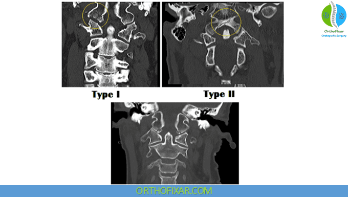Occipital Condyle Fractures