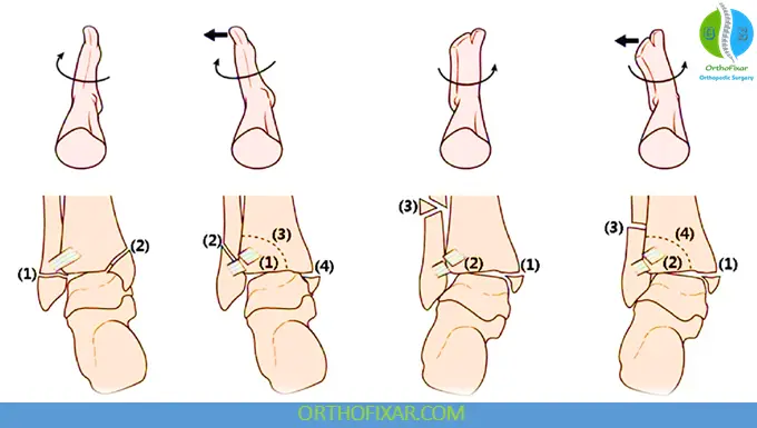Ankle Fractures - Lauge-Hansen Classification