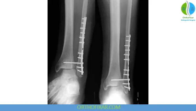 Ankle Fractures Syndesmotic Fixation
