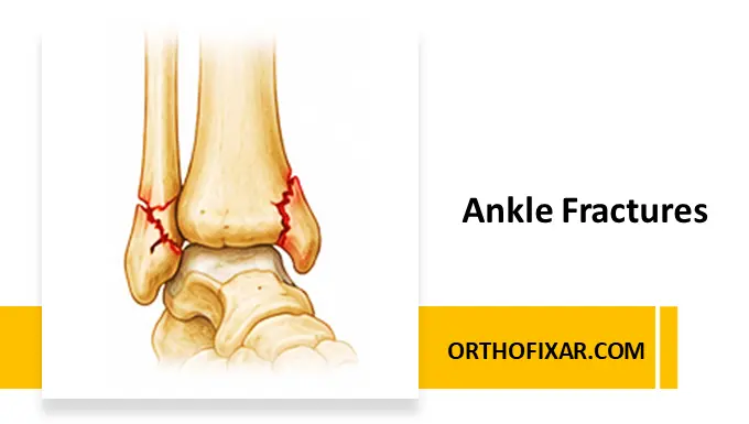 Ankle Fractures Treatment