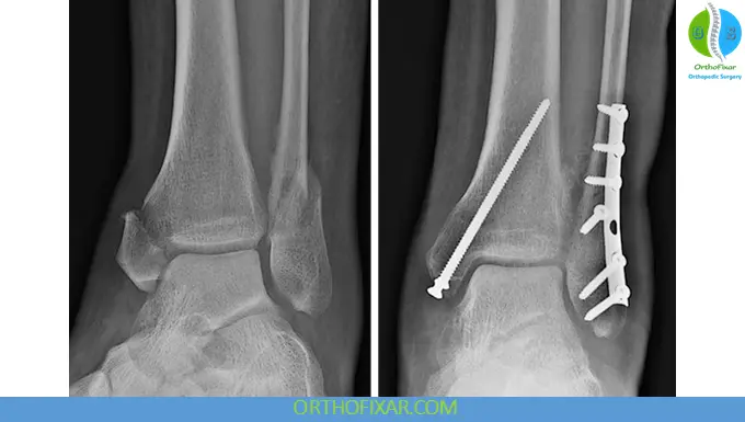 Ankle Fractures surgery fixation