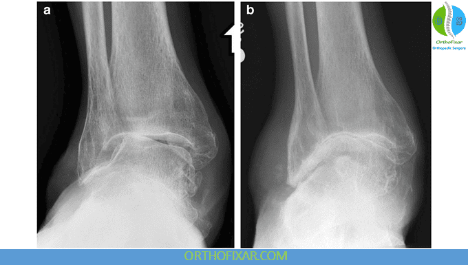 Ankle Osteoarthritis: Symptoms, Bracing & Treatment Options 5 Ankle Osteoarthritis imaging