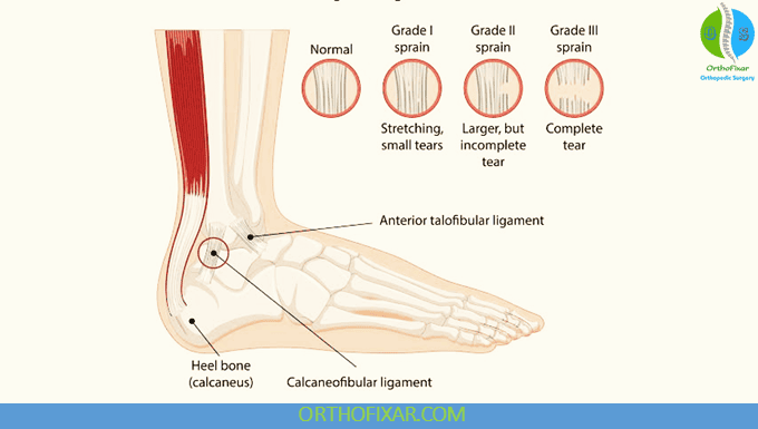 Ankle Sprain grades