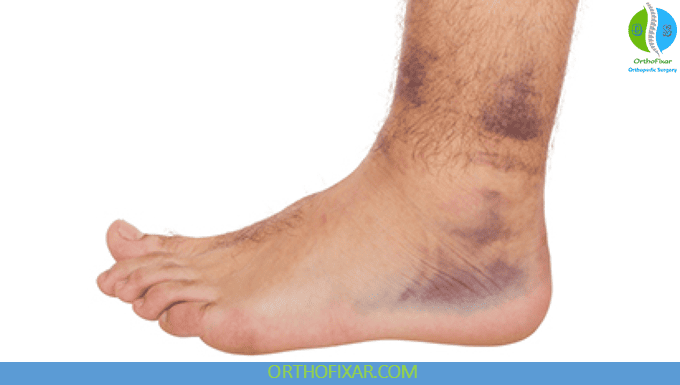 Ankle Sprain symptoms
