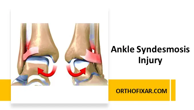 Ankle Syndesmosis Injury Diagnosis, Imaging & Treatment