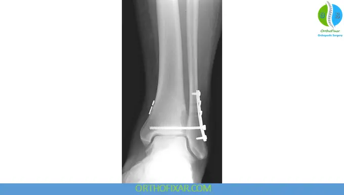 Ankle Syndesmosis Injury Treatment