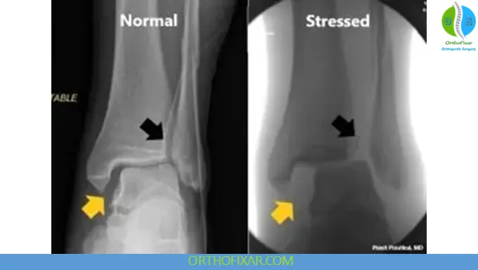 Ankle Syndesmosis Injury xray