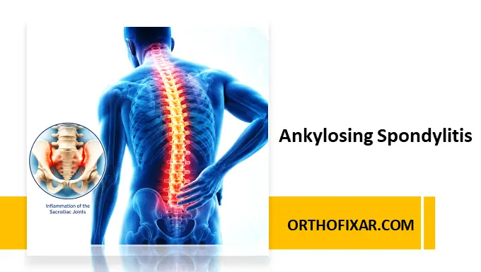 Ankylosing spondylitis