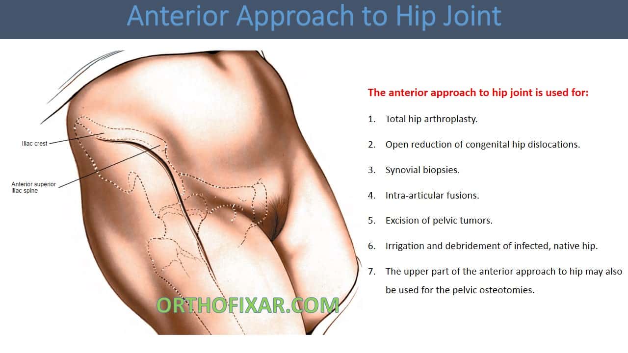  Anterior Approach to Hip Joint 