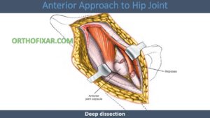 Smith-Petersen Anterior Hip Approach: Surgical Technique & Indications