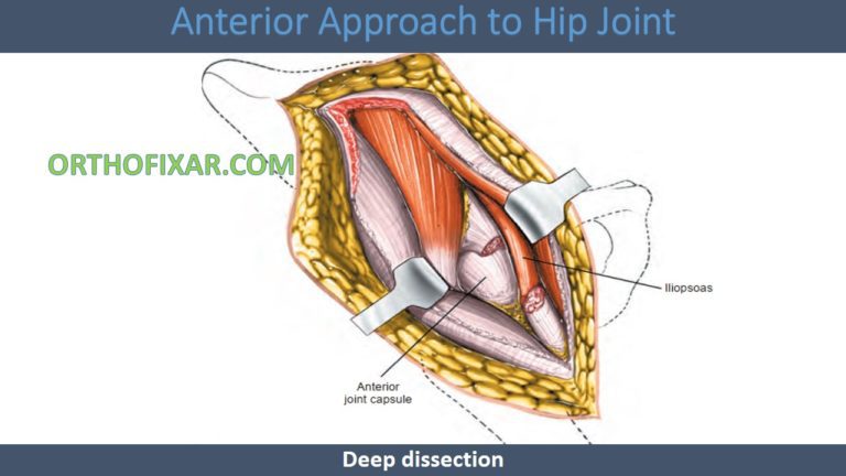 Smith-Petersen Anterior Hip Approach: Surgical Technique & Indications