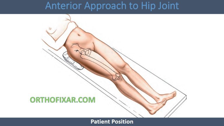Smith-Petersen Anterior Hip Approach: Surgical Technique & Indications
