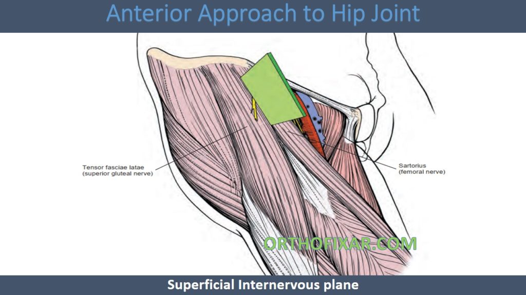 Anterior Approach to Hip - Smith-Petersen approach Joint